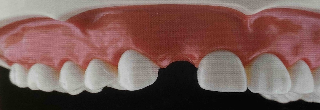 neue Zähne vorher Komp 1080